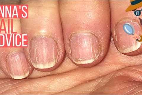 How To Care For Ridgy Nails  [ANNA''S NAIL ADVICE] 🕵️‍♀️