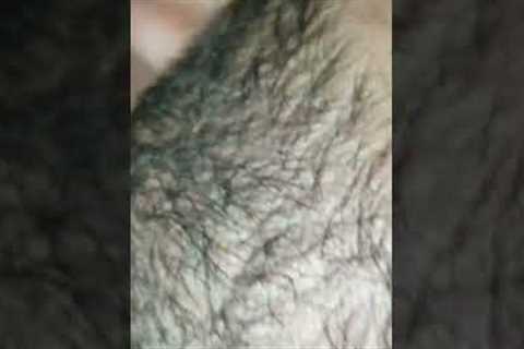 #ingrownhair #hair #beard #trending #asmr #satisfying #waxing #ImranKhan #ingrown