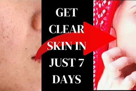 How To Get Clear Skin | Summer Skin Care | Diy Remedy |