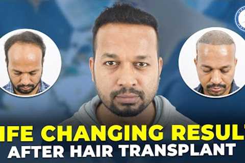 Best Hair Transplant in Pune || Before After Result || Grafts 3005